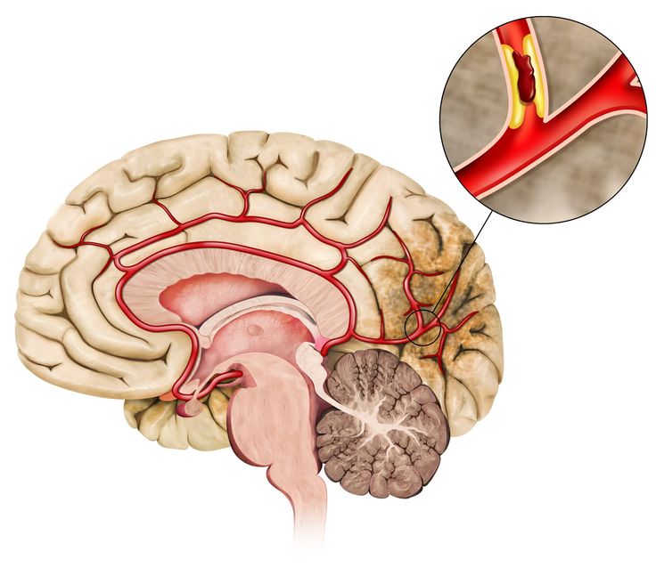 Thé qui guérit de l'AVC et de la paralysie