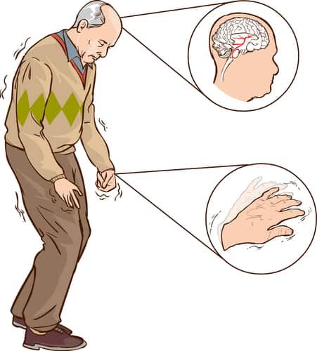 Thé qui guérit de l'AVC et de la paralysie